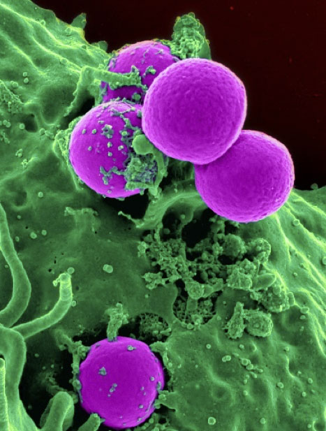 Epstein Barr Virus Pfeiffersche Drüsenfieber